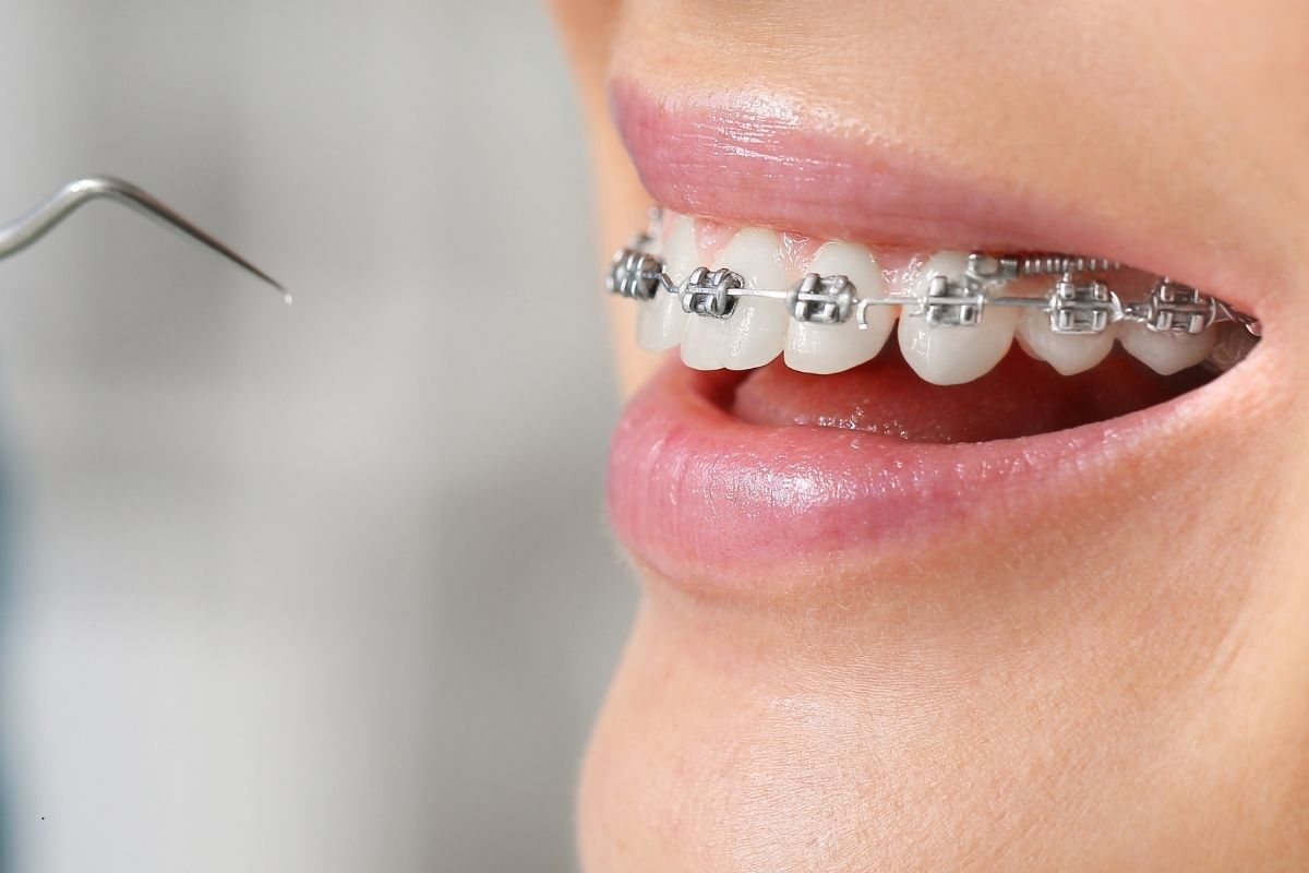 From First Consult to Final Reveal: What to Expect When Starting Braces at True North Orthodontics